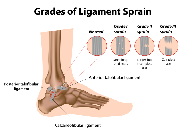 ankle sprain types