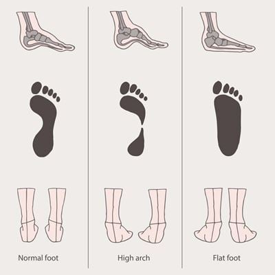 Reasons for Foot Pain While Walking
